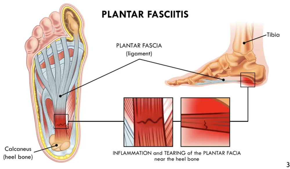 arch support inserts plantar fasciitis